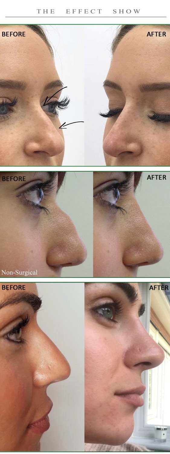 closed vs open rhinoplasty