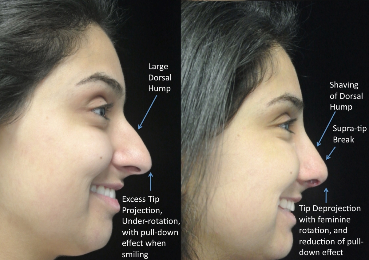 closed vs open rhinoplasty