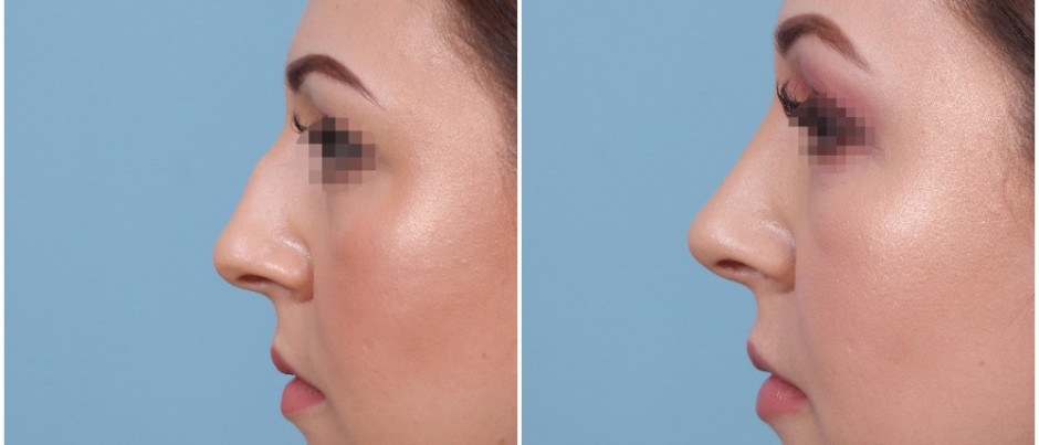 closed vs open rhinoplasty